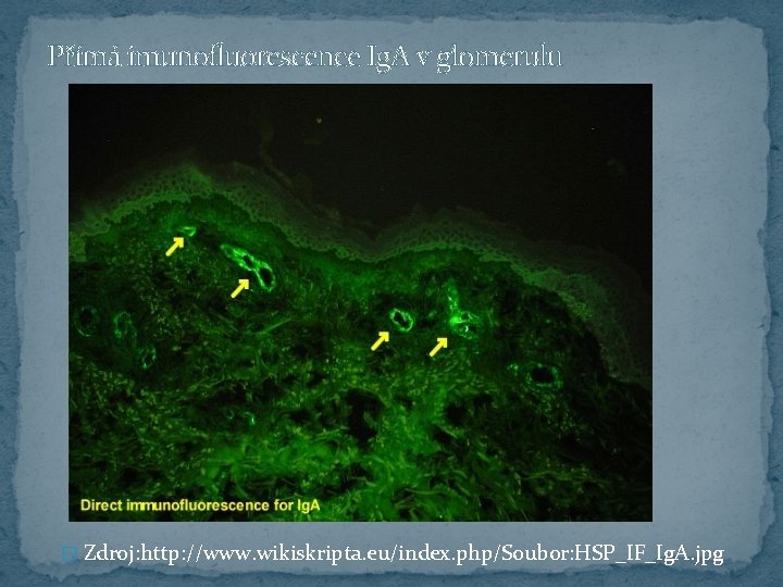 Přímá imunofluorescence Ig. A v glomerulu � Zdroj: http: //www. wikiskripta. eu/index. php/Soubor: HSP_IF_Ig.