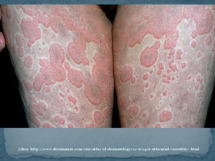 Zdroj: http: //www. dermaamin. com/site/atlas-of-dermatology/20 -u/1476 -urticarial-vasculitis-. html 