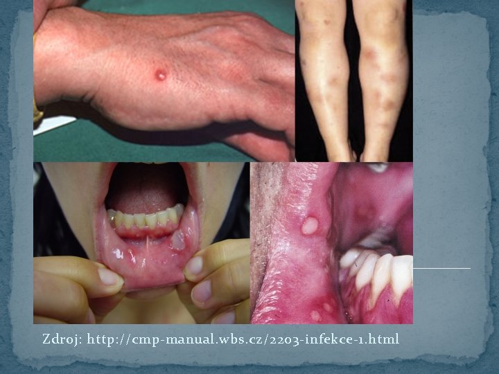 Zdroj: http: //cmp-manual. wbs. cz/2203 -infekce-1. html 