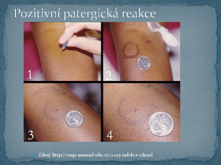 Pozitivní patergická reakce � Zdroj: http: //cmp-manual. wbs. cz/2203 -infekce-1. html 