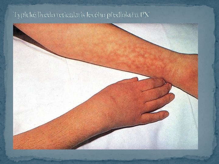 Typické livedo reticularis levého předloktí u PN 
