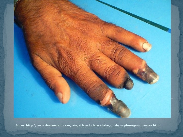 Zdroj: http: //www. dermaamin. com/site/atlas-of-dermatology/2 -b/204 -buerger-disease-. html 