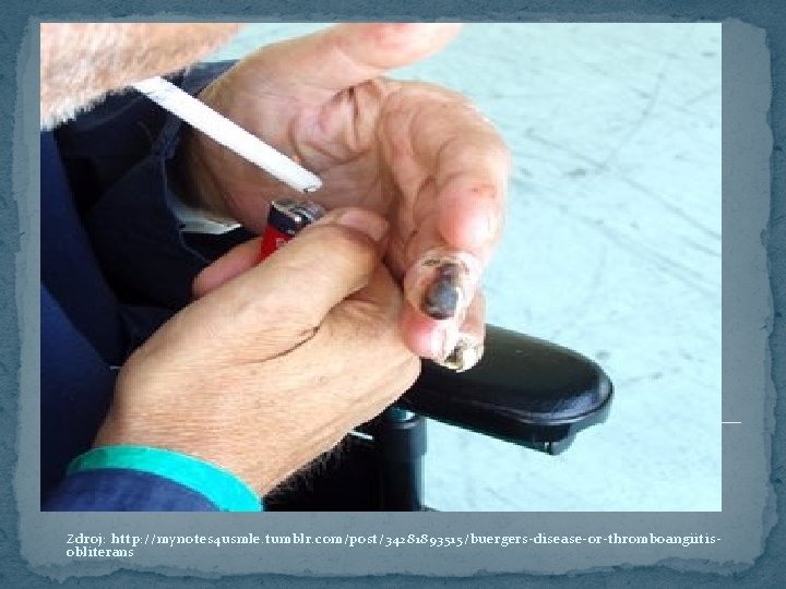 Zdroj: http: //mynotes 4 usmle. tumblr. com/post/34281893515/buergers-disease-or-thromboangiitisobliterans 