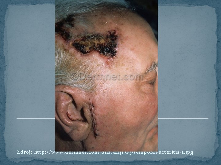 Zdroj: http: //www. dermnet. com/dn 2/all. JPG 3/temporal-arteritis-1. jpg 