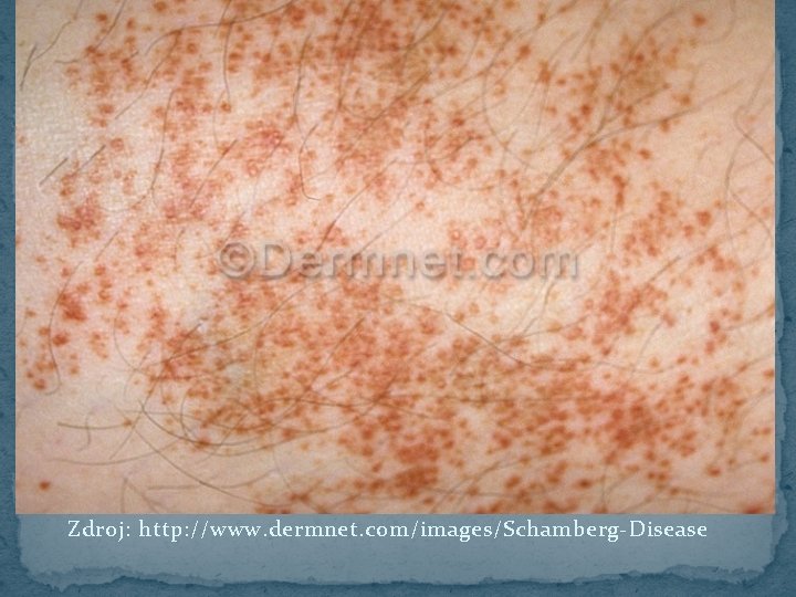 Zdroj: http: //www. dermnet. com/images/Schamberg-Disease 