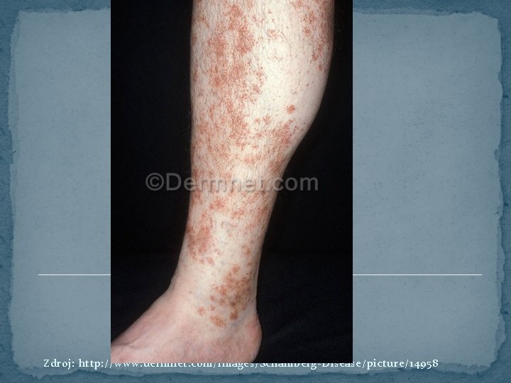 Zdroj: http: //www. dermnet. com/images/Schamberg-Disease/picture/14958 