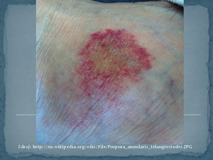 Zdroj: http: //en. wikipedia. org/wiki/File: Purpura_annularis_telangiectodes. JPG 