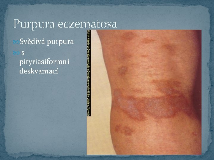 Purpura eczematosa Svědivá purpura s pityriasiformní deskvamací 
