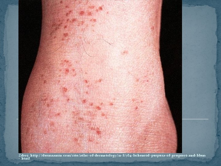 Zdroj: http: //dermaamin. com/site/atlas-of-dermatology/11 -l/784 -lichenoid-purpura-of-gougerot-and-blum -. html 