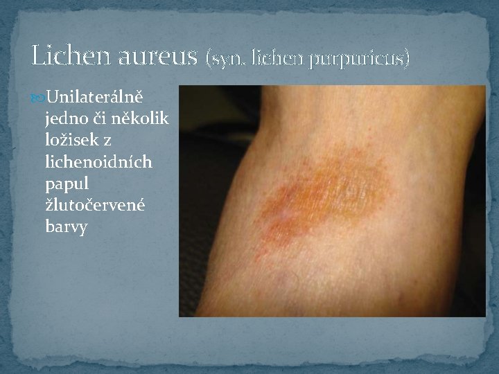 Lichen aureus (syn. lichen purpuricus) Unilaterálně jedno či několik ložisek z lichenoidních papul žlutočervené