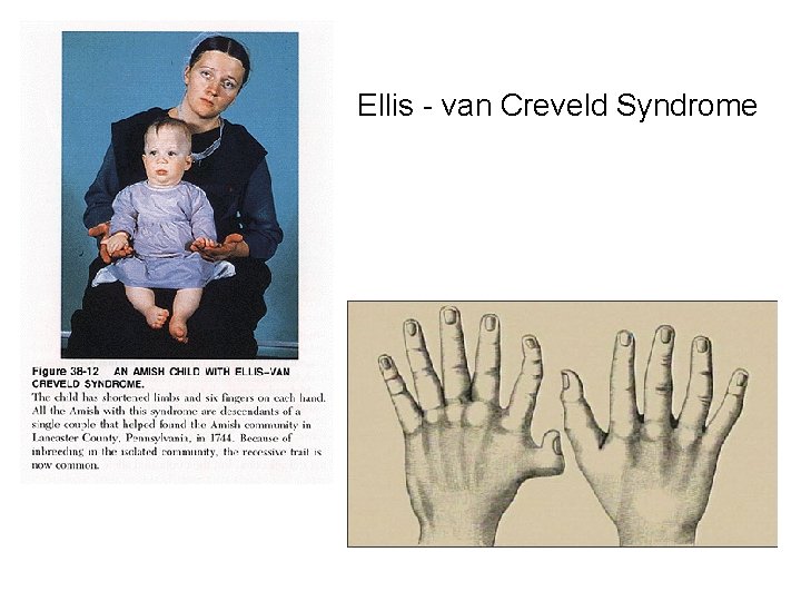 Ellis - van Creveld Syndrome 