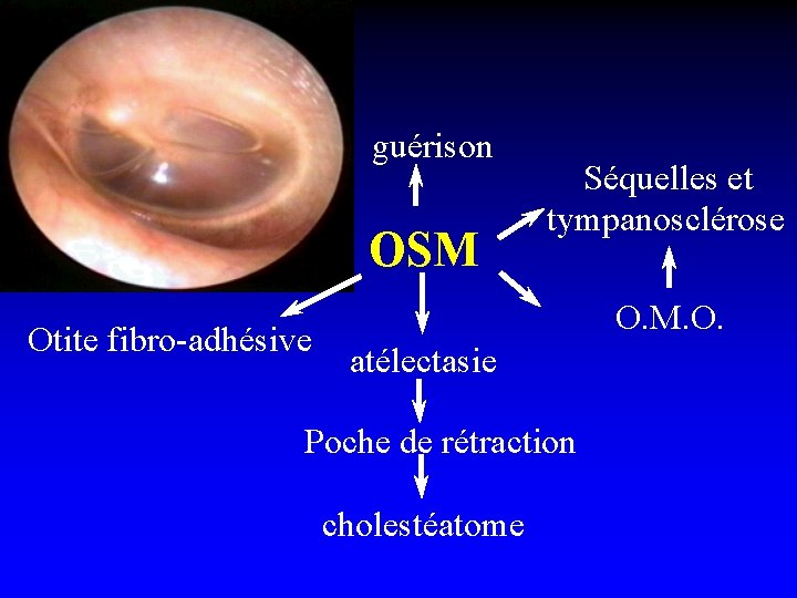 guérison OSM Otite fibro-adhésive Séquelles et tympanosclérose O. M. O. atélectasie Poche de rétraction