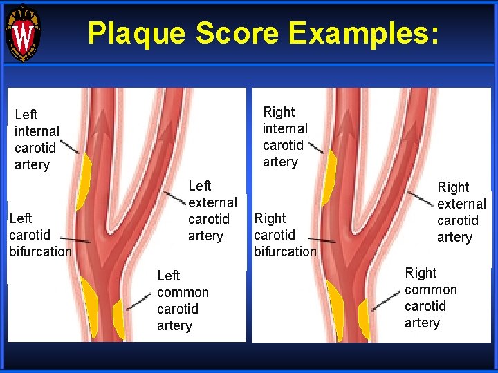 Plaque Score Examples: Right internal carotid artery Left carotid bifurcation Left external carotid artery