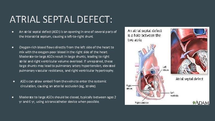 ATRIAL SEPTAL DEFECT: ● An atrial septal defect (ASD) is an opening in one