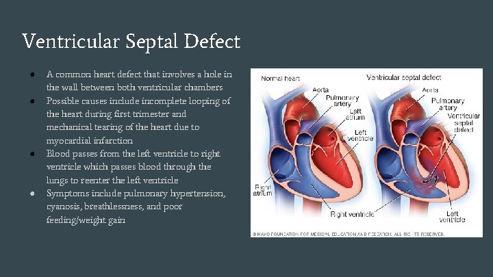 Ventricular Septal Defect ● ● A common heart defect that involves a hole in