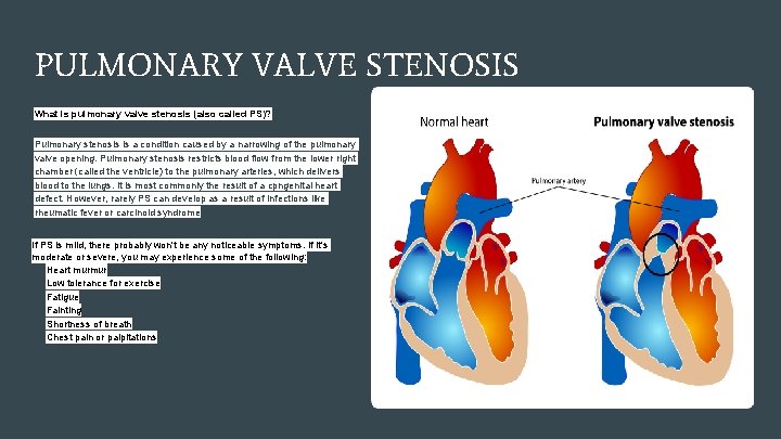 PULMONARY VALVE STENOSIS What is pulmonary valve stenosis (also called PS)? Pulmonary stenosis is