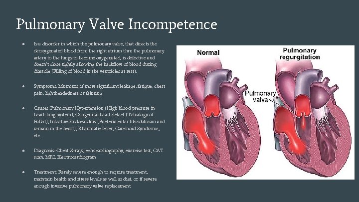 Pulmonary Valve Incompetence ● Is a disorder in which the pulmonary valve, that directs