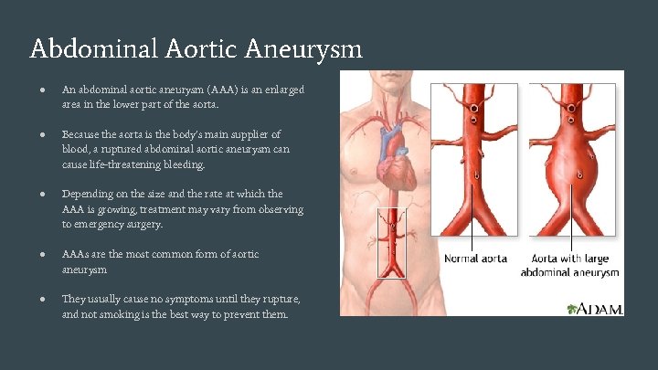Abdominal Aortic Aneurysm ● An abdominal aortic aneurysm (AAA) is an enlarged area in
