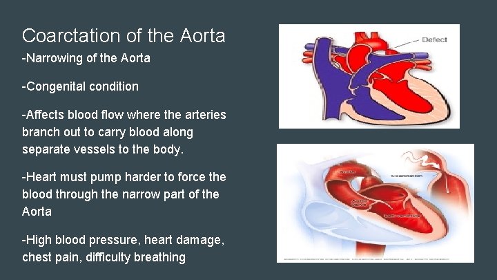 Coarctation of the Aorta -Narrowing of the Aorta -Congenital condition -Affects blood flow where