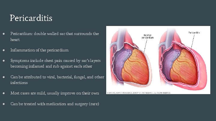 Pericarditis ● Pericardium: double walled sac that surrounds the heart ● Inflammation of the