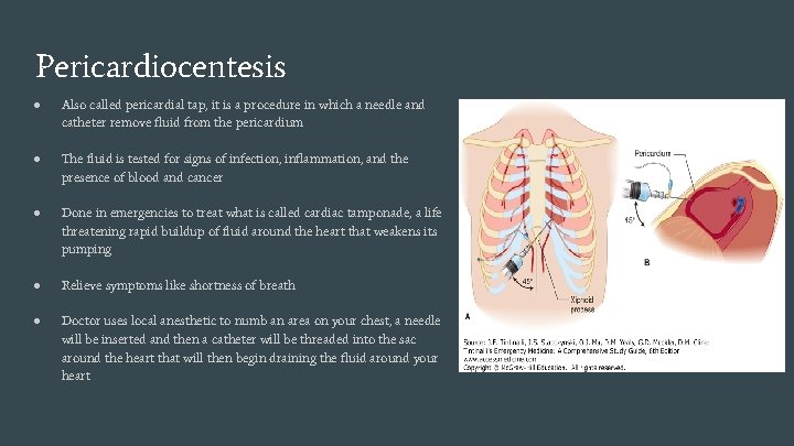 Pericardiocentesis ● Also called pericardial tap, it is a procedure in which a needle