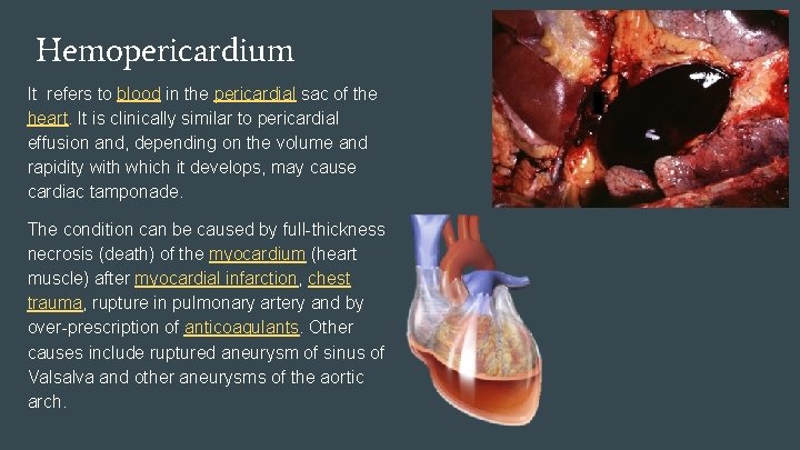 Hemopericardium It refers to blood in the pericardial sac of the heart. It is