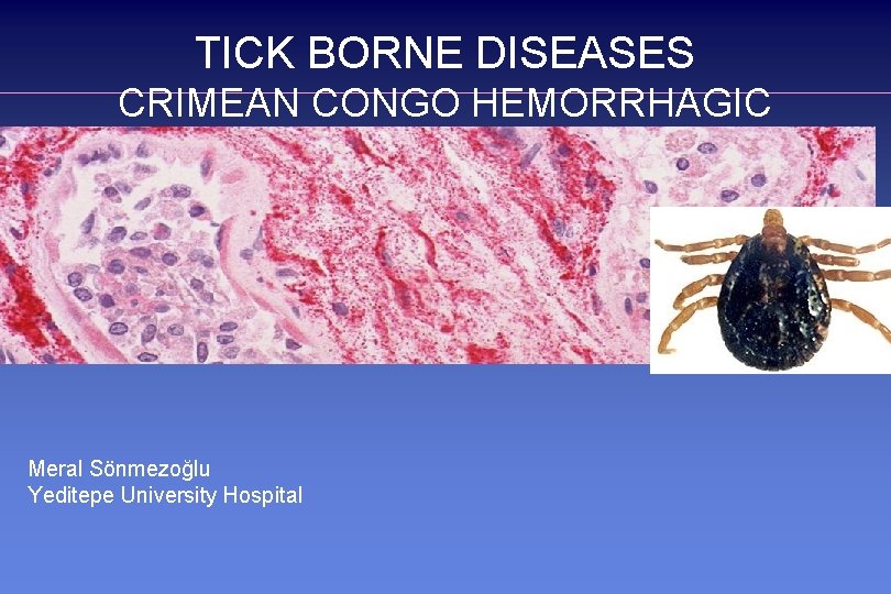 TICK BORNE DISEASES CRIMEAN CONGO HEMORRHAGIC FEVER Meral Sönmezoğlu Yeditepe University Hospital 