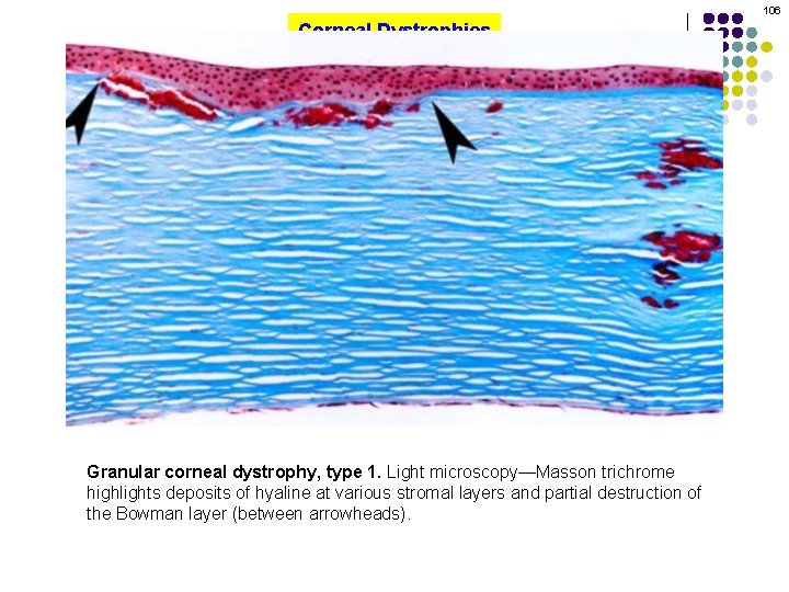 106 Corneal Dystrophies Granular corneal dystrophy, type 1. Light microscopy—Masson trichrome highlights deposits of