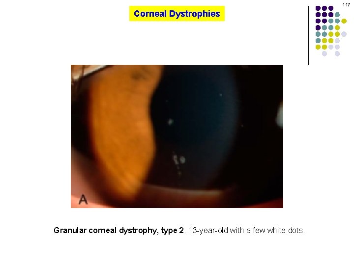 117 Corneal Dystrophies Granular corneal dystrophy, type 2. 13 -year-old with a few white