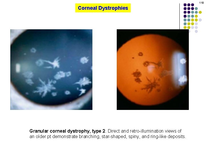 118 Corneal Dystrophies Granular corneal dystrophy, type 2. Direct and retro-illumination views of an