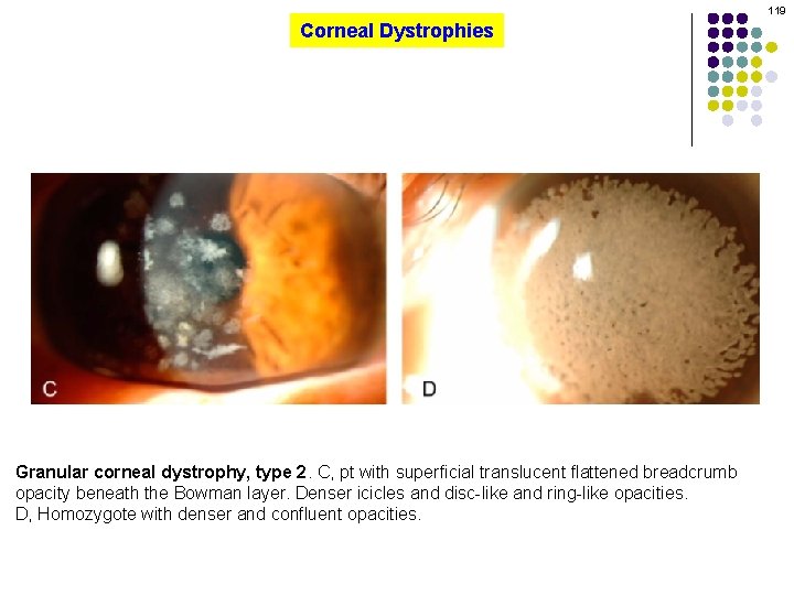 119 Corneal Dystrophies Granular corneal dystrophy, type 2. C, pt with superficial translucent flattened