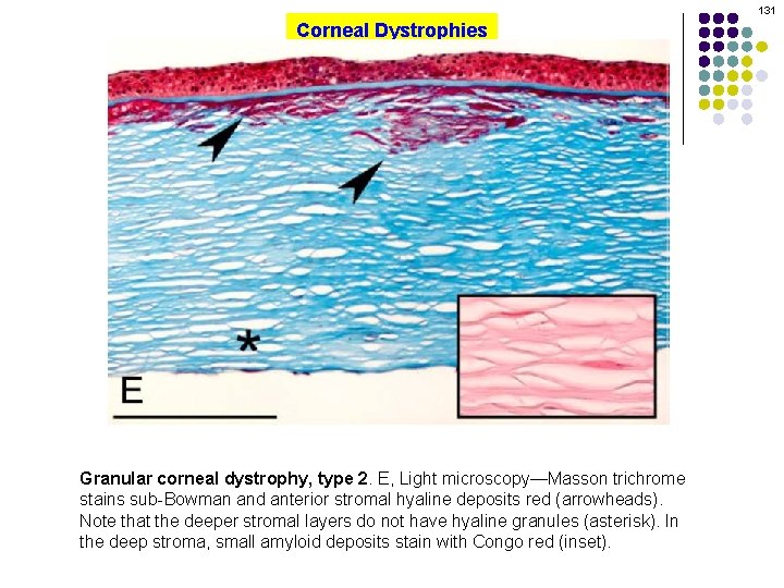 131 Corneal Dystrophies Granular corneal dystrophy, type 2. E, Light microscopy—Masson trichrome stains sub-Bowman