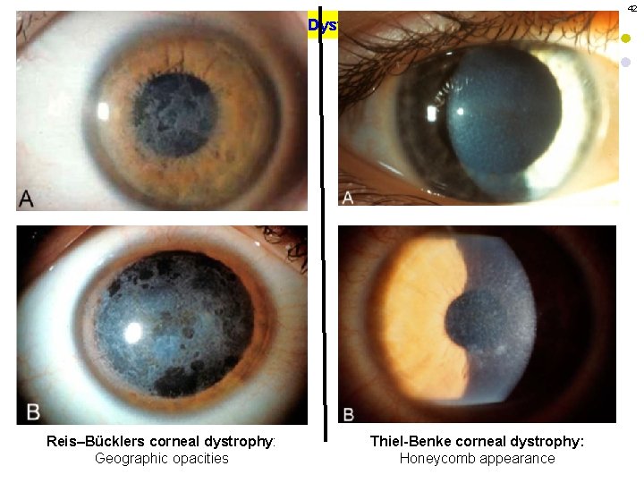 42 Corneal Dystrophies Reis–Bücklers corneal dystrophy: Geographic opacities Thiel-Benke corneal dystrophy: Honeycomb appearance 