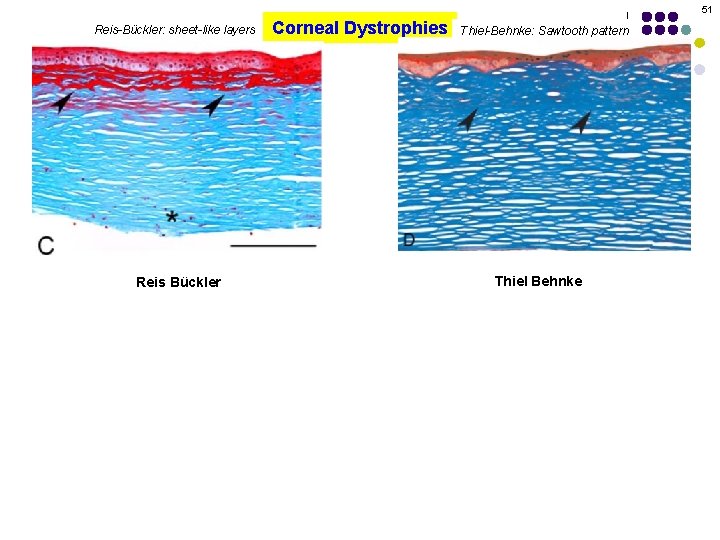 51 Reis-Bückler: sheet-like layers Reis Bückler Corneal Dystrophies Thiel-Behnke: Sawtooth pattern Thiel Behnke 