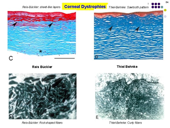 54 Reis-Bückler: sheet-like layers Reis Bückler Reis-Bückler: Rod-shaped fibers Corneal Dystrophies Thiel-Behnke: Sawtooth pattern