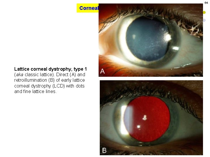 64 Corneal Dystrophies Lattice corneal dystrophy, type 1 (aka classic lattice). Direct (A) and