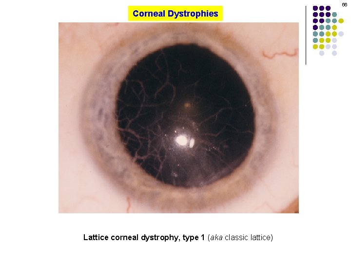 66 Corneal Dystrophies Lattice corneal dystrophy, type 1 (aka classic lattice) 