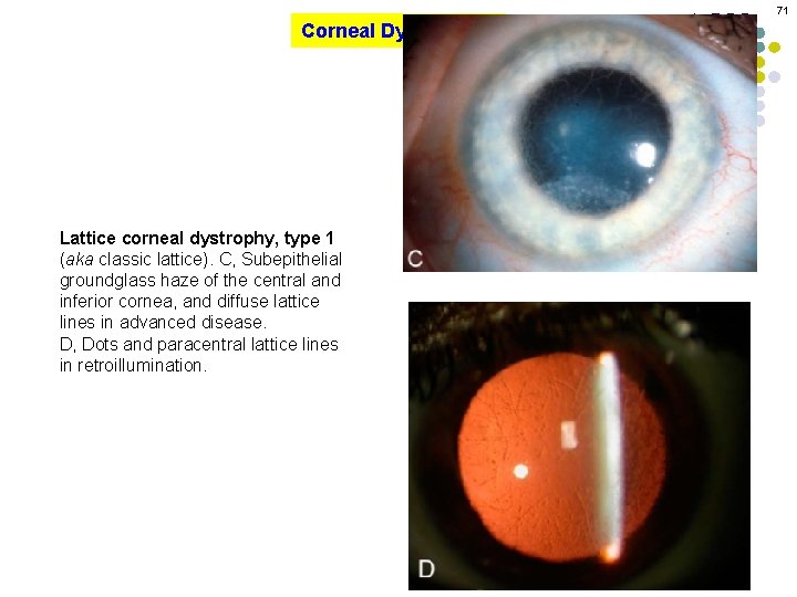 71 Corneal Dystrophies Lattice corneal dystrophy, type 1 (aka classic lattice). C, Subepithelial groundglass