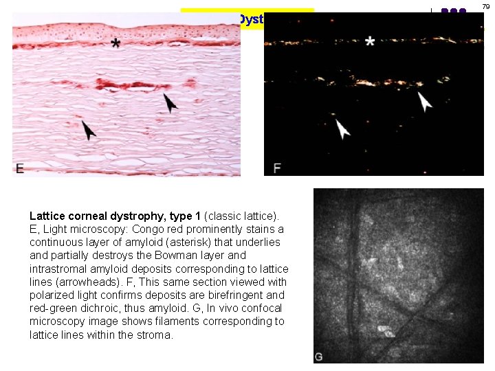 79 Corneal Dystrophies Lattice corneal dystrophy, type 1 (classic lattice). E, Light microscopy: Congo
