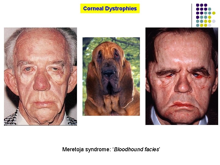 Corneal Dystrophies Meretoja syndrome: ‘Bloodhound facies’ 