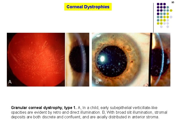 96 Corneal Dystrophies Granular corneal dystrophy, type 1. A, In a child, early subepithelial