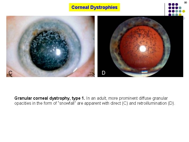 98 Corneal Dystrophies Granular corneal dystrophy, type 1. In an adult, more prominent diffuse