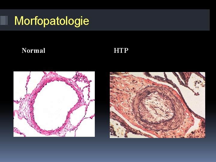 Morfopatologie Normal HTP 