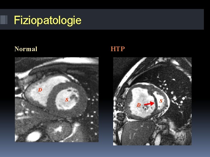 Fiziopatologie Normal HTP D S 