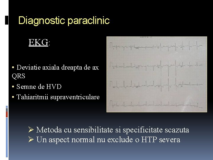 Diagnostic paraclinic EKG: • Deviatie axiala dreapta de ax QRS • Semne de HVD