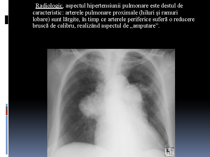 Radiologic, aspectul hipertensiunii pulmonare este destul de caracteristic: arterele pulmonare proximale (hiluri şi ramuri