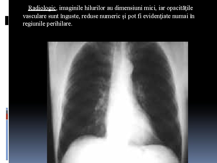 Radiologic, imaginile hilurilor au dimensiuni mici, iar opacităţile vasculare sunt înguste, reduse numeric şi