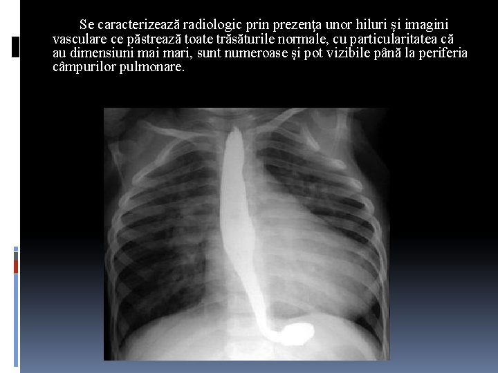 Se caracterizează radiologic prin prezenţa unor hiluri şi imagini vasculare ce păstrează toate trăsăturile