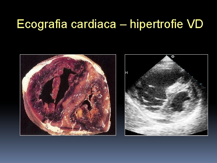 Ecografia cardiaca – hipertrofie VD 