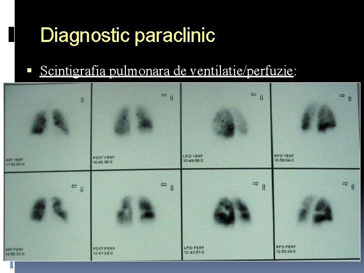 Diagnostic paraclinic Scintigrafia pulmonara de ventilatie/perfuzie: Poate fi perfect normala Defecte de perfuzie periferice